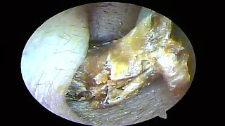 Remove two large cerumen plugs and dry fungus pieces from the ears and clean them（20241025） [upl. by Lekkim360]