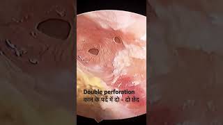 double perforation in eardrum [upl. by Basilio]