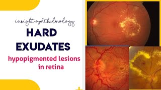 HARD EXUDATES  Hypopigmented lesions of the retina [upl. by Lauryn]