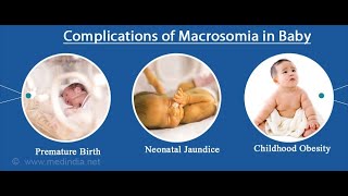 Fetal Macrosomia  Definition Causes Symptoms Effects Treatment [upl. by Kcirdneked220]