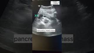 Cancer of head of pancreas  Pancreatic carcinoma ultrasonography radiology [upl. by Engis260]