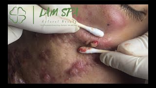 Treatment of acne pustules severe inflammation  MrL Part2  Điều trị mụn mủ viêm nặng  LAMSPA [upl. by Traci]