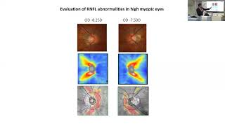 Primary Open Angle Glaucoma Dr Christopher Leung [upl. by Iredale]