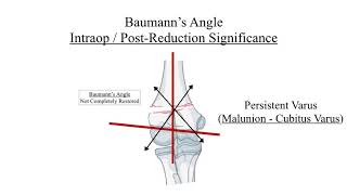 Queries on Supracondylar Humerus Fracture in Children  For MBBS [upl. by Phylis]