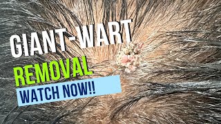 Live video of wart removal at Dermosphere Clinic [upl. by Lativa]