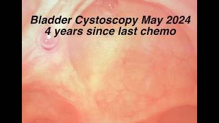 Bladder Cystoscopy 4 Years after Chemo Ended May 2024 [upl. by Hamel]