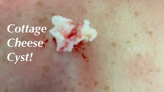 Cottage Cheese Cyst [upl. by Areema538]