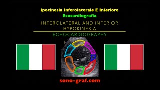 Ecocardiografia  Ipocinesia Inferolaterale E Inferiore [upl. by Edak328]