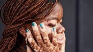 Vitiligo Demystified Causes symptoms and solutions [upl. by Sixele]