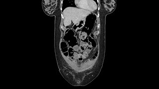 Pseudo obstruction of bowels  Ogilvie syndrome [upl. by Helfant754]