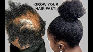 YOUR HAIR WILL GROW LIKE CRAZY GROW HAIR Long Thick amp Healthy FAST [upl. by Hars]