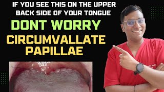 Dr Rudra If you see this on the upper back side of your tongue DONT WORRY Circumvallate Papillae [upl. by Maggi]