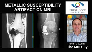 Metallic susceptibility artifact on MRI [upl. by Genesia]