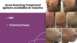 Acne Scarring Treatment l Acne Scars l Acne Marks l Dark Spots l Skin Clinic l Twacha l Dwarka [upl. by Early956]