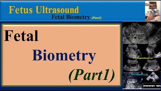 Fetus Ultrasound Fetal BiometryPart1 [upl. by Machute]