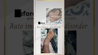 Atopic dermatitis cured with homoeopathy dermatitispaediatriccurewithhomoeopathy [upl. by Eirol]