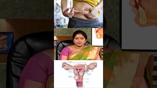 Fibroid கட்டி வர முக்கிய காரணம் இதுதான் 😳 [upl. by Lillie]