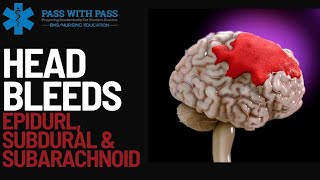 Head Bleeds Epidural Subdural amp Subarrachnoid  A Quick Review [upl. by Ardnuasal338]