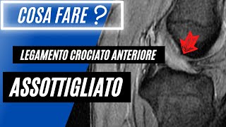 Legamento crociato anteriore assottigliato 🟠  Cosa Significa❓ [upl. by Allx]