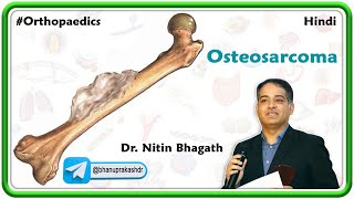 Osteosarcoma Hindi  Orthopedic Lectures [upl. by Vivie]