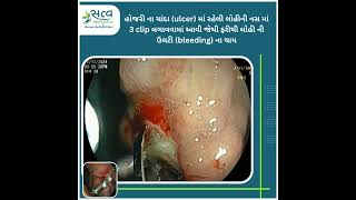 Gastric ulcer treatment by Endoscopy bhavnagar bhavnagari gastroenterologist [upl. by Ahsieit631]