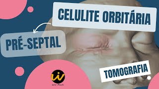 CELULITE ORBITÁRIA PRÉSEPTAL na Tomografia de Face [upl. by Mychael]