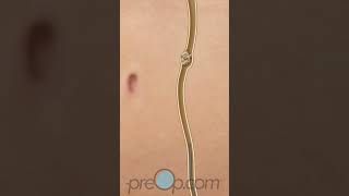 PreOp® 🎯 Choosing the Right Procedure for Kidney Stones preop shorts health 🤔 [upl. by Adieren]