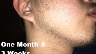 NOTICEABLE CHANGES amp PIMPLES 7 Weeks Minoxidil Journey FilipinoAsian QUICK UPDATE [upl. by Celin]