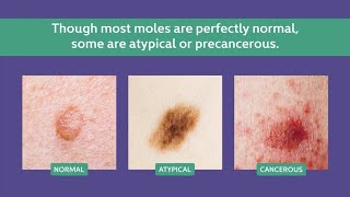 Atypical Moles vs Precancerous Moles vs Normal Moles  SERO [upl. by Punke]