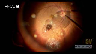 The Craft of Retinal Autograft [upl. by Araeic975]