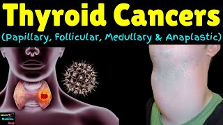 Thyroid Cancers Papillary Follicular Medullary amp Anaplastic  Classification of Thyroid Neoplasm [upl. by Khichabia]