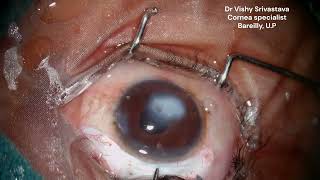 Creating precise Optical Iridectomy without using Vitrectomy cutter [upl. by Viviana]