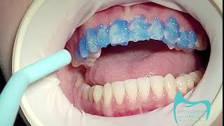 فينير فلدسباثك بدون حف اسنان Feldspathic veneers without teeth grinding [upl. by Esinyl229]