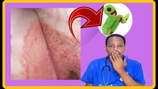 THE TINEA CRURIS CAMBAARTA KU DHACDA MAQAARKA XUBNAHA TARANKA CALAMADAHA LAGU GARTO DRMAHAMED LIBAN [upl. by Harahs]