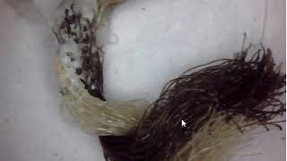 Morgellons Disease What is it  Morgellons is A Fungi  More Update [upl. by Eirffej150]