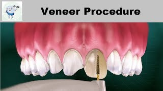 Dental Veneers Procedure Step by step [upl. by Salakcin]