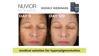 Join us for an exclusive webinar that will transform your approach to hyperpigmentation treatments [upl. by Niobe]