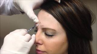 Allergan Botox Injections [upl. by Lled]