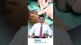 Treatment for Haemorrhoids  Dr Mahesh Chikkachannappa  Aster CMI Hospital [upl. by Dermot]