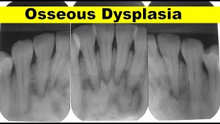 Osseous Dysplasia Case Presentation [upl. by Noletta]