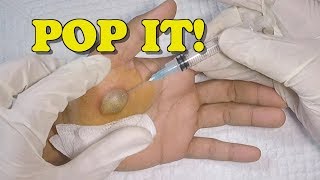 Popping a Huge Hand Blister [upl. by Filip961]