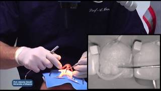 IPS Empress Direct StepbyStep with Prof Antonio Cerutti [upl. by Anytsyrk195]