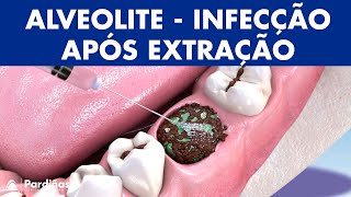 ALVEOLITE  Infecção após extração dente causas e tratamento © [upl. by Epuladaug763]