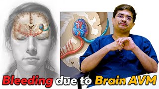 What is Brain AVM  ArterioVenous Malformation AVM  Treatment Options [upl. by Nollahs725]