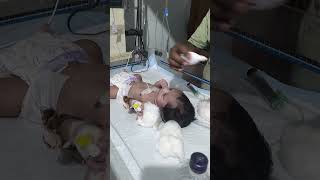 Putting drops in the nose of a newborn baby sumitnicunursingstm youtubeshorts newbornbaby drop [upl. by Eissoj812]