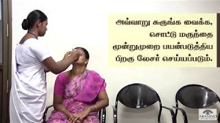 YAG PI Laser  செயல்முறை விளக்கம் [upl. by Naret]