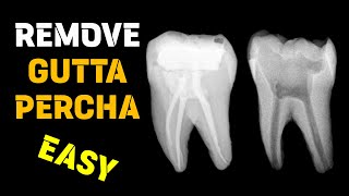 Gutta percha removal  Endodontic retreatment [upl. by Duyne74]