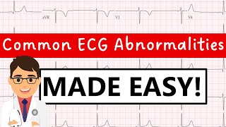 Common ECG abnormalities  MADE EASY [upl. by Teyut]