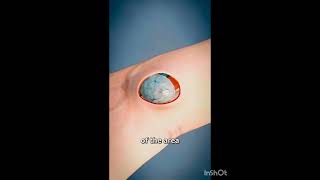 Ganglion Cyst execsion ganglion wristpain swelling [upl. by Ube]