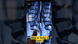 What Is Tarlov s Cyst  Dr Sai Chandra [upl. by Ronoh]